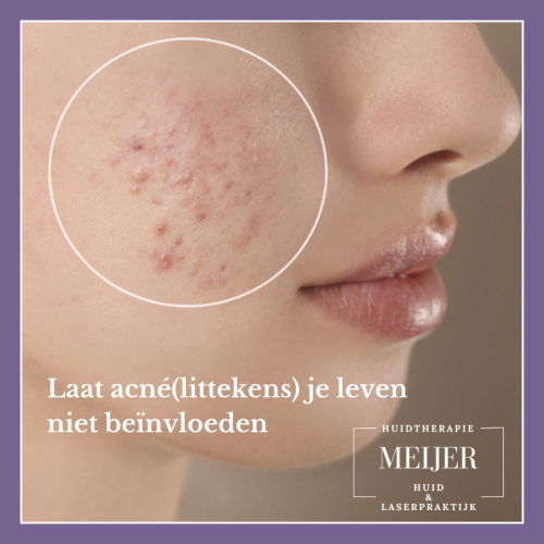 Acne_20241127_215707_0000 Acne_20241127_215707_0000